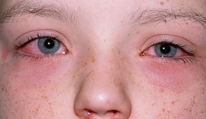 Symptom of Anaphylaxis - read, itchy eyes