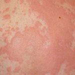 Symptom of Anaphylaxis - Hives skin rash