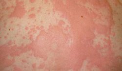 Symptom of Anaphylaxis - Hives skin rash